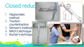 Closed reduction
1. Hippocretes
method
2. Traction-
countertraction
3. Stimson’s method
4. Milch’s technique
5. Kocher’s technique
 