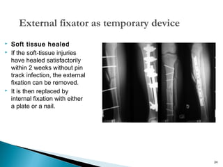 External fixator as temporary device





Soft tissue healed
If the soft-tissue injuries
have healed satisfactorily
within 2 weeks without pin
track infection, the external
fixation can be removed.
It is then replaced by
internal fixation with either
a plate or a nail.

24

 