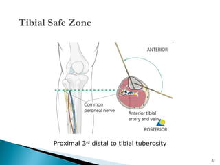 Tibial Safe Zone

Proximal 3rd distal to tibial tuberosity
33

 