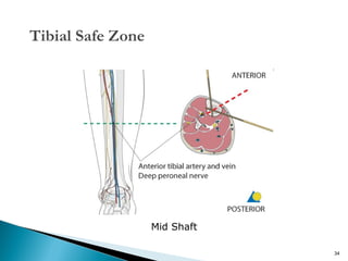Tibial Safe Zone

Mid Shaft
34

 