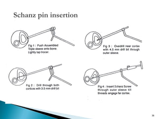 Schanz pin insertion

36

 
