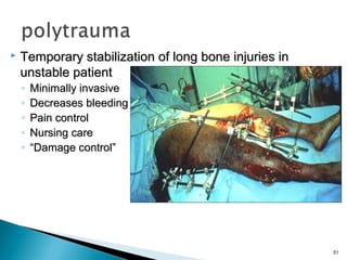 

Temporary stabilization of long bone injuries in
unstable patient
◦
◦
◦
◦
◦

Minimally invasive
Decreases bleeding
Pain control
Nursing care
“Damage control”

51

 