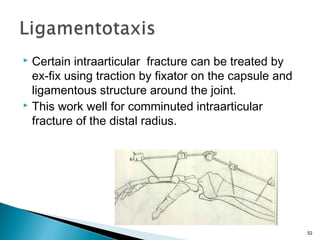 Certain intraarticular fracture can be treated by
ex-fix using traction by fixator on the capsule and
ligamentous structure around the joint.
 This work well for comminuted intraarticular
fracture of the distal radius.


52

 