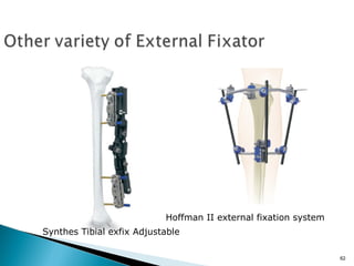 Hoffman II external fixation system
Synthes Tibial exfix Adjustable
62

 