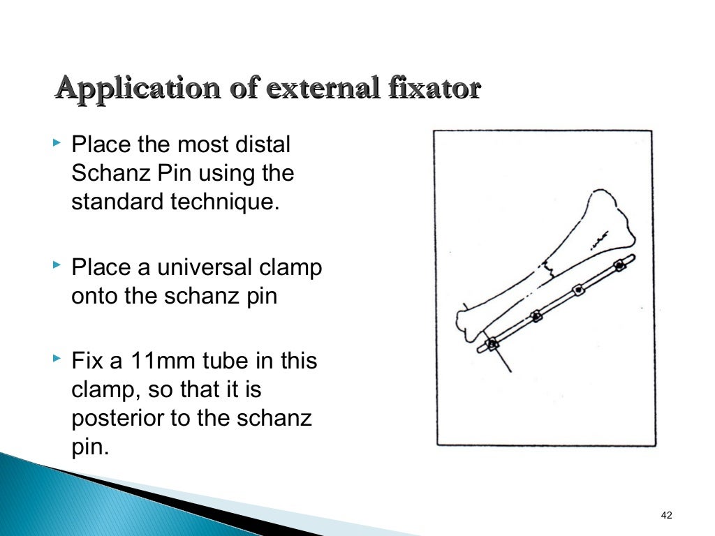 External fixator