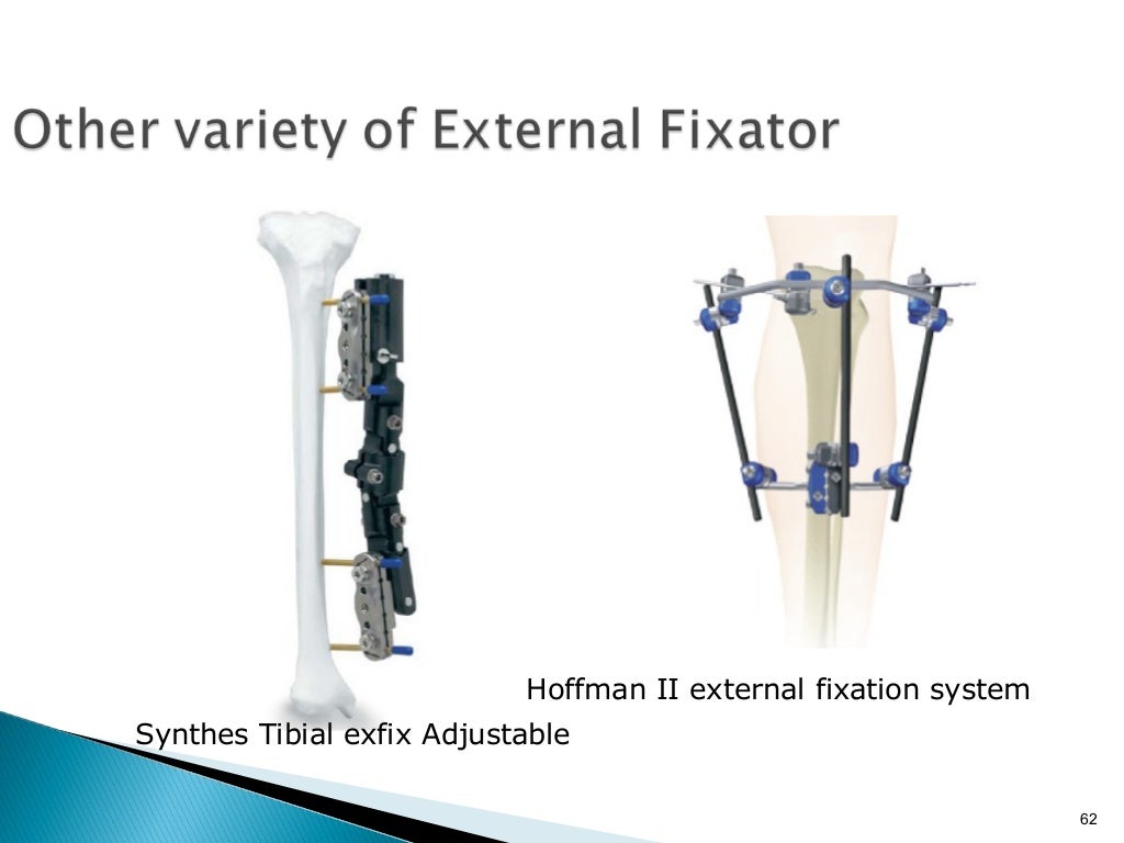 External fixator