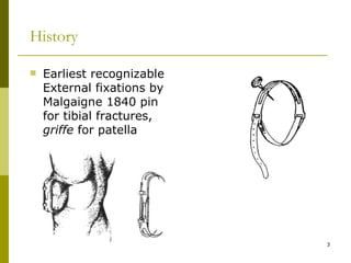 Tibia Fractures: Ilizarov / Circular Wire Fixators : Wheeless' Textbook of  Orthopaedics