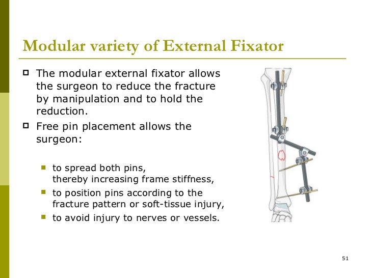 External fixator