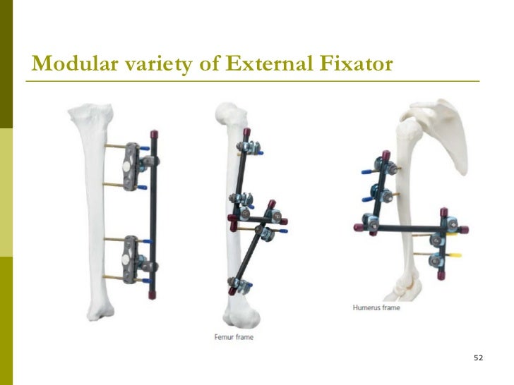 External fixator