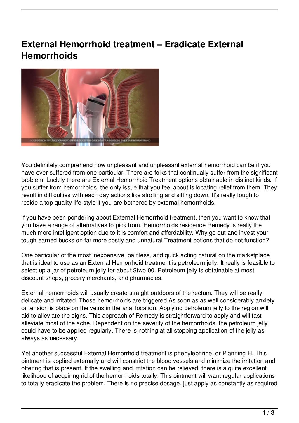 External Hemorrhoid treatment Eradicate External Hemorrhoids