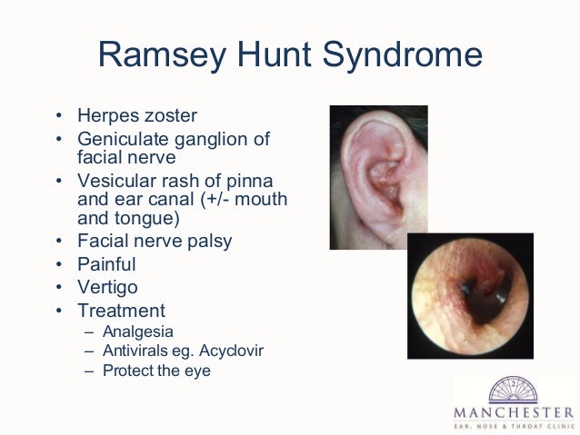 External and middle ear disease for g ps