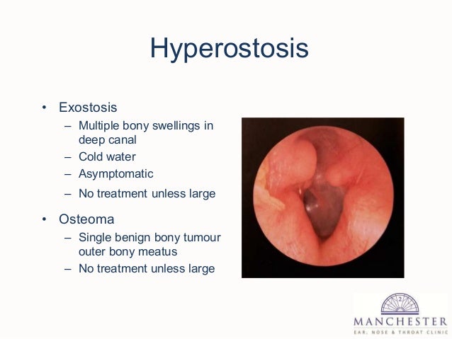 What Are Exostoses Of The Ear Canal? – EYDY