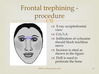 
drtbalu's otolaryngology online 40
Frontal trephining -
procedure
 X-ray occipitofrontal
view
 GA/LA
 Infiltration of xylocaine
should block trochlear
nerve
 Incision is sited as
shown in the figure
 Drill is used to
perforate the bone
 