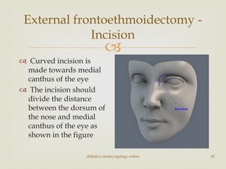 
drtbalu's otolaryngology online 45
External frontoethmoidectomy -
Incision
 Curved incision is
made towards medial
canthus of the eye
 The incision should
divide the distance
between the dorsum of
the nose and medial
canthus of the eye as
shown in the figure
 