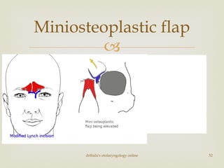 
drtbalu's otolaryngology online 52
Miniosteoplastic flap

 