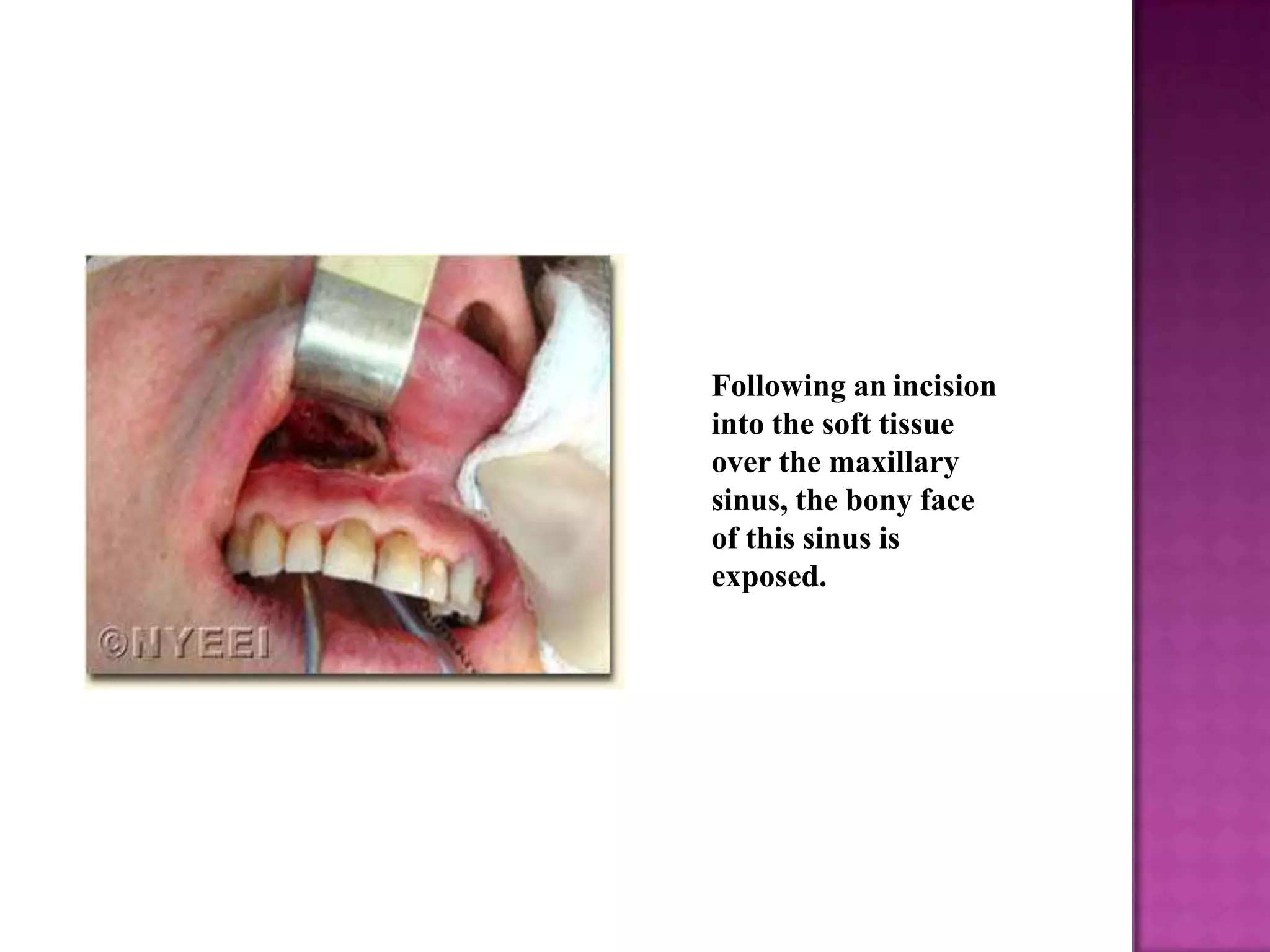 Following an incision
into the soft tissue
over the maxillary
sinus, the bony face
of this sinus is
exposed.
 