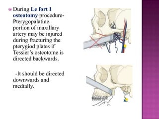  During

Le fort I
osteotomy procedurePterygopalatine
portion of maxillary
artery may be injured
during fracturing the
pterygiod plates if
Tessier‘s osteotome is
directed backwards.
-It should be directed
downwards and
medially.

 