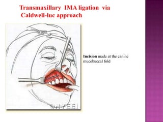 Transmaxillary IMA ligation via
Caldwell-luc approach

Incision made at the canine
mucobuccal fold

 
