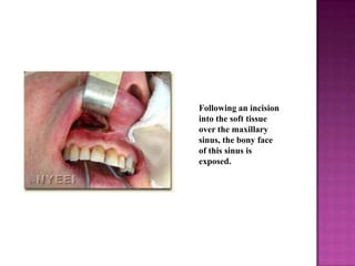 Following an incision
into the soft tissue
over the maxillary
sinus, the bony face
of this sinus is
exposed.

 