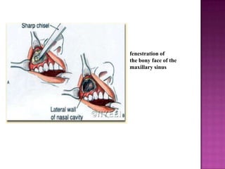 fenestration of
the bony face of the
maxillary sinus

 