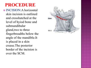  INCISION:A horizontal

skin incision is outlined
and crosshatched at the
level of hyiod bone and
submandibular
gland,two to three
fingerbreadths below the
angle of the mandible.It
is placed in a skin
crease.The posterior
border of the incision is
over the SCM.

 