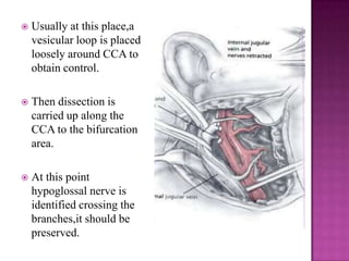

Usually at this place,a
vesicular loop is placed
loosely around CCA to
obtain control.



Then dissection is
carried up along the
CCA to the bifurcation
area.



At this point
hypoglossal nerve is
identified crossing the
branches,it should be
preserved.

 
