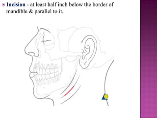 Incision

- at least half inch below the border of
mandible & parallel to it.

 