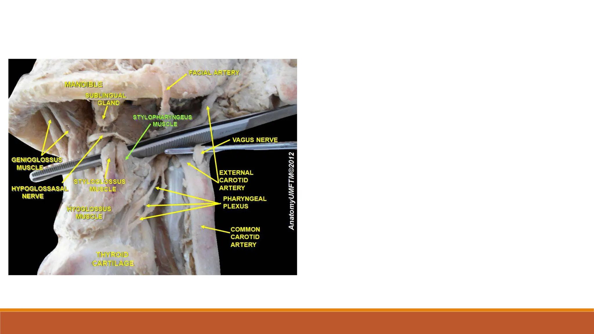 External carotid artery , ligation of External carotid artery, lingual ...