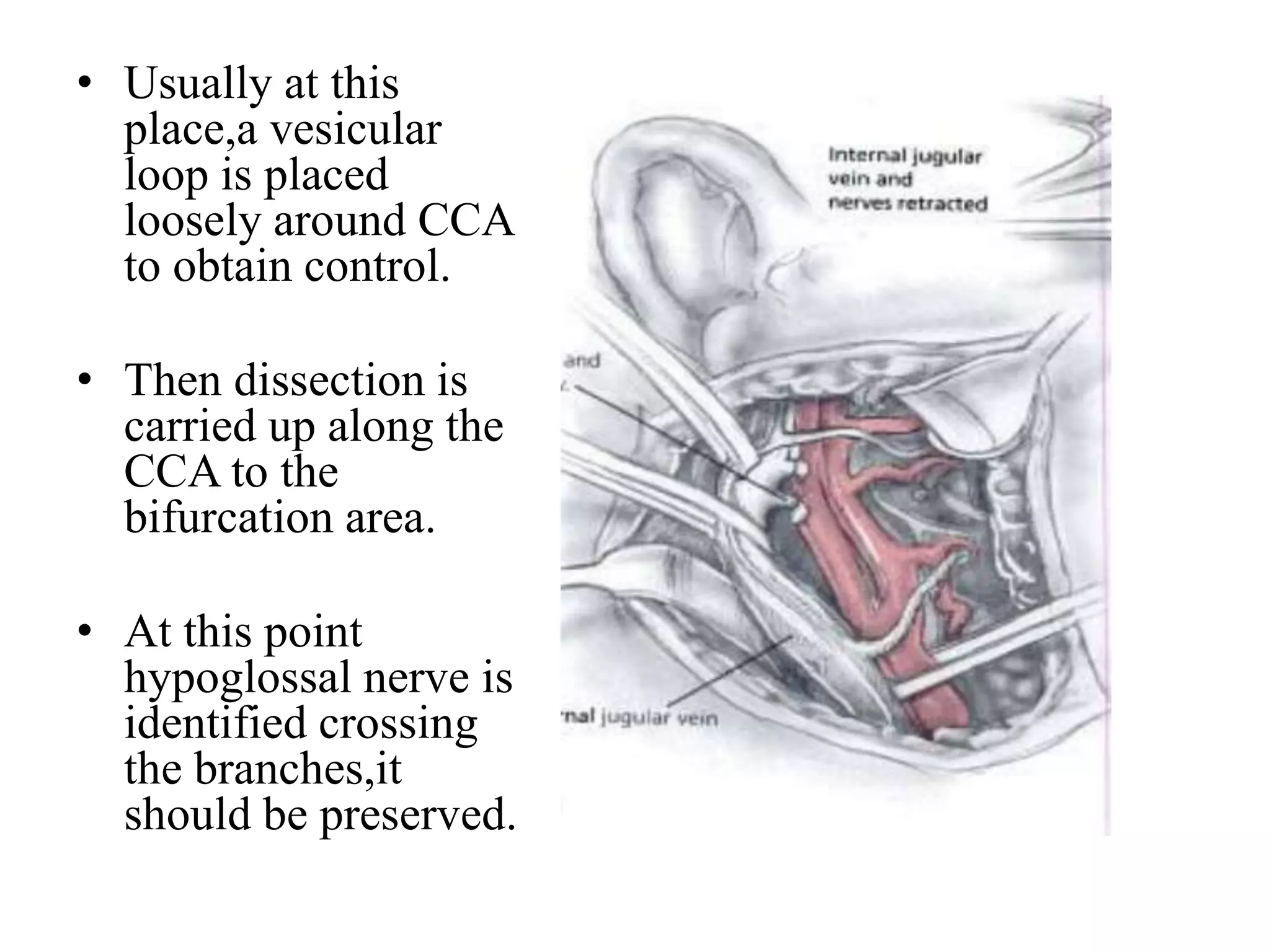 External carotid artery, branches and ligation | PPTX