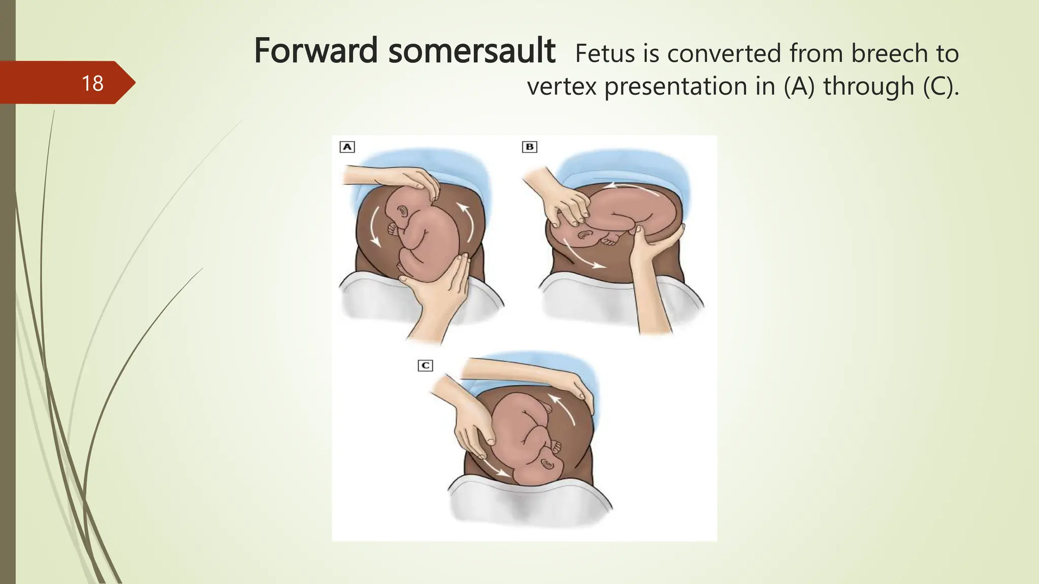 EXTERNAL CEPHALIC VERSION BY DR Alphonse.pptx