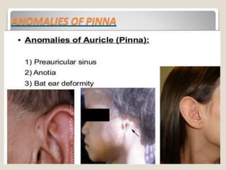 ANOMALIES OF PINNA
 