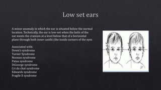 A minor anomaly in which the ear is situated below the normal
location. Technically, the ear is low-set when the helix of the
ear meets the cranium at a level below that of a horizontal
plane through both inner canthi (the inside corners of the eyes
Associated with:
Down's syndrome
Turner Syndrome
Noonan syndrome
Patau syndrome
DiGeorge syndrome
Cri du chat syndrome
Edwards syndrome
Fragile X syndrome
 