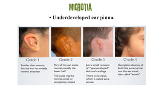 Microtia
• Underdeveloped ear pinna.
 