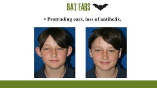 Bat ears
• Protruding ears, loss of antihelix.
 