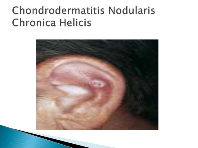 Diseases of External Ear