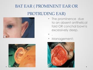 BAT EAR ( PROMINENT EAR OR
PROTRUDING EAR)
• The prominence due
to an absent antihelical
fold OR conchal bowl is
excessively deep.
• .
• Management:
 