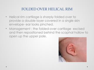 FOLDED OVER HELICAL RIM
• Helical rim cartilage is sharply folded over to
provide a double layer covered in a single skin
envelope- ear looks pinched.
• Management : the folded-over cartilage excised
and then repositioned behind the scaphal hollow to
open up the upper pole.
 
