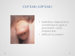 CUP EAR ( LOP EAR )
• Definition: Helical rim is
constricted to give a
prominent, cone-
shaped ear.
• Difficult to correct.
 