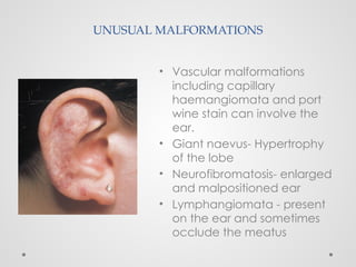 UNUSUAL MALFORMATIONS
• Vascular malformations
including capillary
haemangiomata and port
wine stain can involve the
ear.
• Giant naevus- Hypertrophy
of the lobe
• Neurofibromatosis- enlarged
and malpositioned ear
• Lymphangiomata - present
on the ear and sometimes
occlude the meatus
 