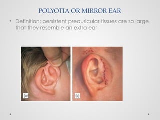 POLYOTIA OR MIRROR EAR
• Definition: persistent preauricular tissues are so large
that they resemble an extra ear
 