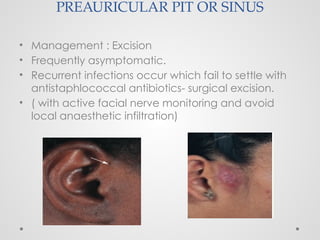 PREAURICULAR PIT OR SINUS
• Management : Excision
• Frequently asymptomatic.
• Recurrent infections occur which fail to settle with
antistaphlococcal antibiotics- surgical excision.
• ( with active facial nerve monitoring and avoid
local anaesthetic infiltration)
 
