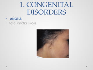 1. CONGENITAL
DISORDERS
• ANOTIA
• Total anotia is rare.
 