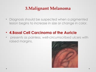 3.Malignant Melanoma
• Diagnosis should be suspected when a pigmented
lesion begins to increase in size or change in color.
• 4.Basal Cell Carcinoma of the Auricle
• presents as painless, well-circumscribed ulcers with
raised margins.
 