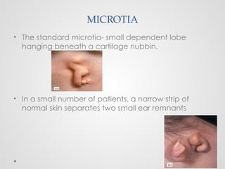 MICROTIA
• The standard microtia- small dependent lobe
hanging beneath a cartilage nubbin.
• In a small number of patients, a narrow strip of
normal skin separates two small ear remnants
 