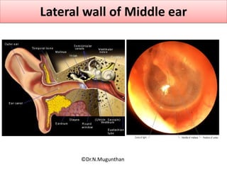 Lateral wall of Middle ear
©Dr.N.Mugunthan
 