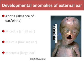 Developmental anomalies of external ear
Anotia (absence of
ear/pinna)
Microtia (small ear)
Melotia (low set ear)
Macrotia (large ear)
©Dr.N.Mugunthan
 