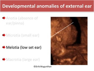 Developmental anomalies of external ear
Anotia (absence of
ear/pinna)
Microtia (small ear)
Melotia (low set ear)
Macrotia (large ear)
©Dr.N.Mugunthan
 