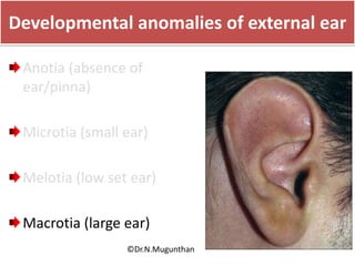 Developmental anomalies of external ear
Anotia (absence of
ear/pinna)
Microtia (small ear)
Melotia (low set ear)
Macrotia (large ear)
©Dr.N.Mugunthan
 