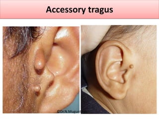Accessory tragus
©Dr.N.Mugunthan
 