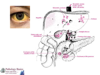 Enteritis Autopsy External examination at autopsy | PPT